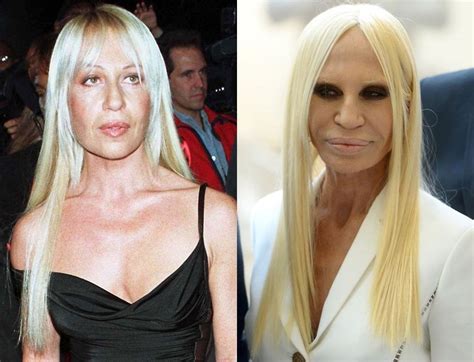 plastische chirurgie versace|donatella Versace before surgery.